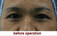 plastic-surgery-blepharoplasty